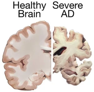 a brain divided into two parts, on the left, there is half of a normal brain, on the right, a brain of a person with Alzheimer's disease.