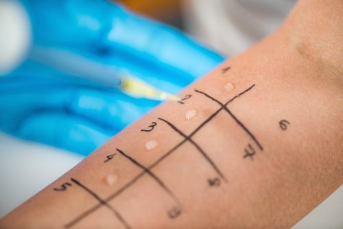 Allergy: skin prick tests on the arm of a woman